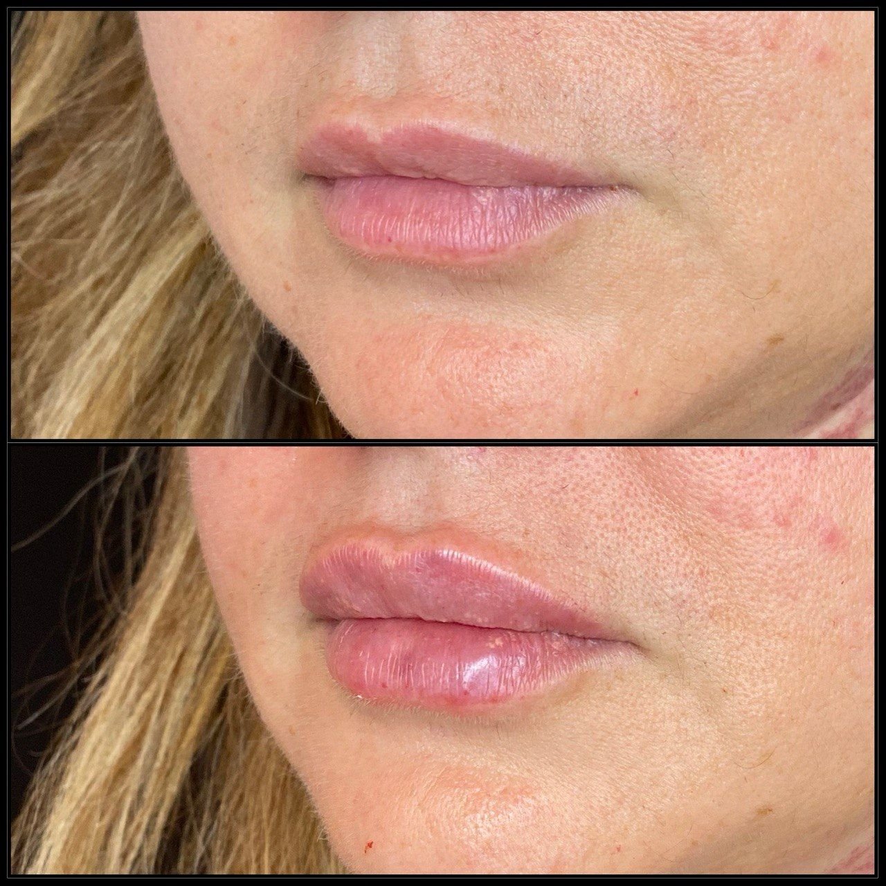 Risultato filler labbra prima e dopo